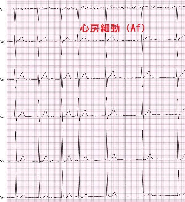 心房細動（Af）心電図（看護rooより）