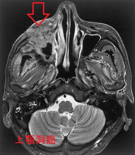 上顎洞癌　MRI画像