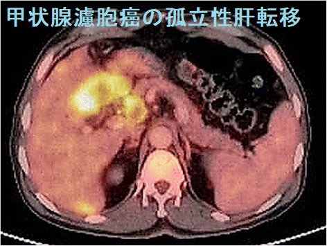 甲状腺濾胞癌の孤立性肝転移