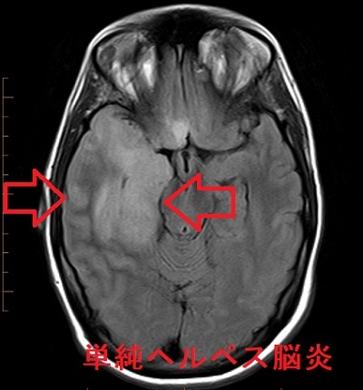 単純ヘルペス脳炎 MRI FLAIR画像