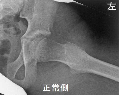 大腿骨頭すべり症 X線写真