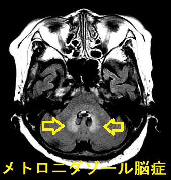 メトロニダゾール脳症　MRI画像