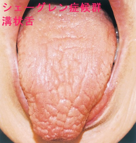 シェーグレン症候群 溝状舌