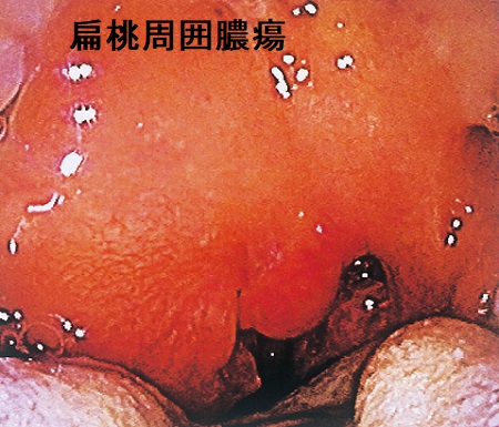扁桃周囲膿瘍