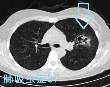 肺吸虫症 CT