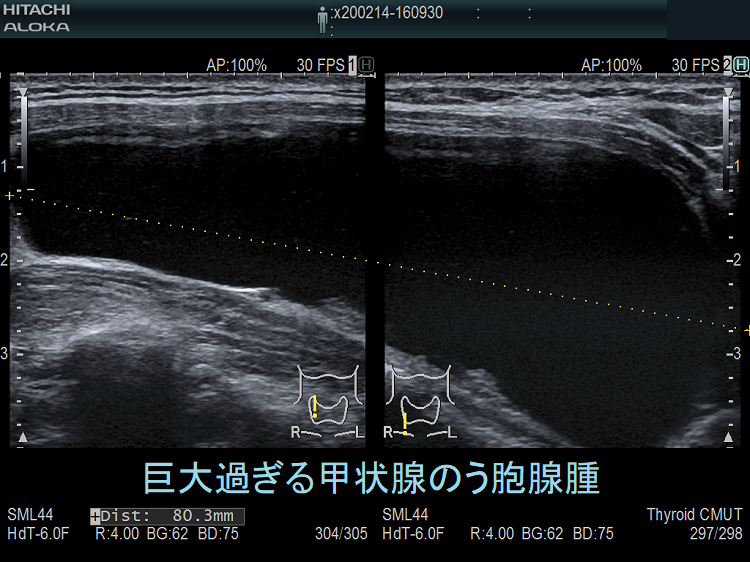 巨大過ぎる甲状腺のう胞腺腫 超音波（エコー）画像(垂直断)
