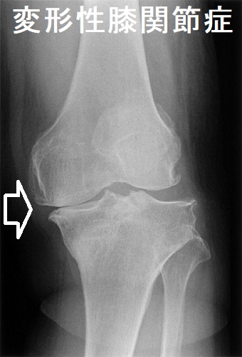 変形性膝関節症 X線画像