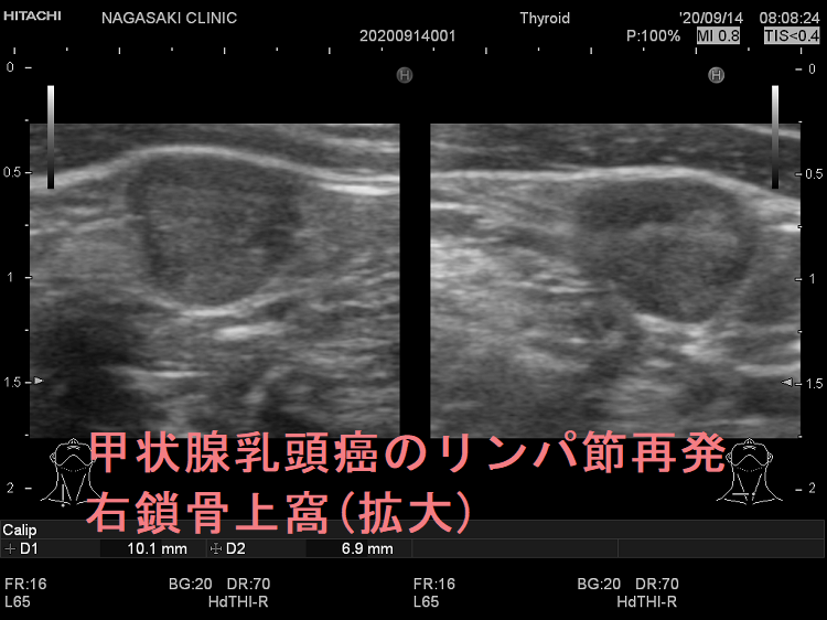 甲状腺乳頭癌のリンパ節再発 右鎖骨上窩 超音波(エコー)画像(拡大)