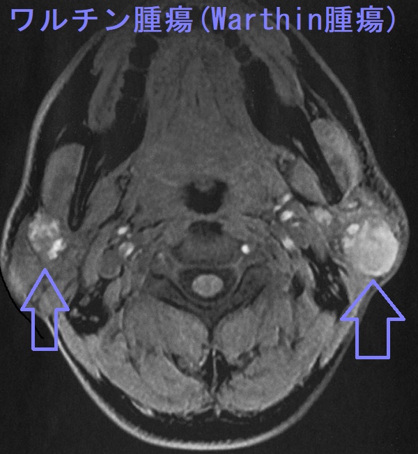 ワルチン腫瘍(Warthin腫瘍)頸部単純MRI 脂肪抑制T1強調水 ワルチン腫瘍(Warthin腫瘍)頸部単純MRI 脂肪抑制T1強調水