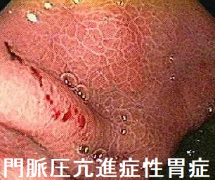 門脈圧亢進症性胃症 門脈圧亢進症性胃症