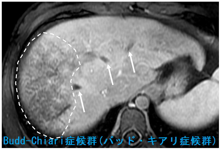 Budd-Chiari症候群(バッド・キアリ症候群)造影MRI門脈相 Budd-Chiari症候群(バッド・キアリ症候群)造影MRI門脈相