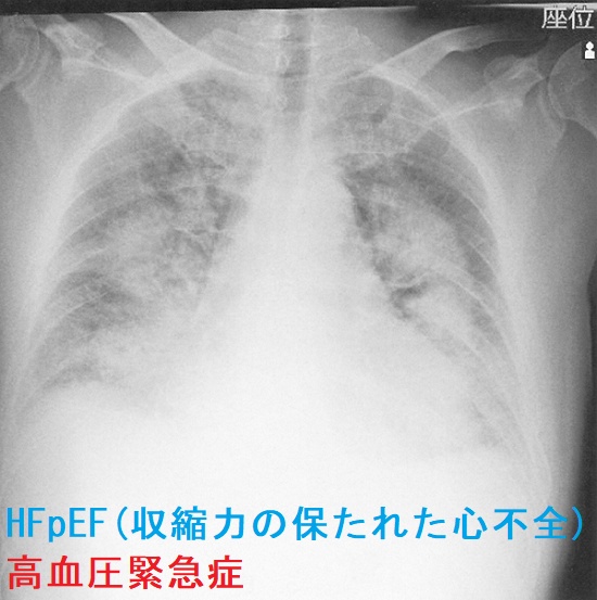 HFpEF(収縮力の保たれた心不全) 高血圧緊急症 胸部エックス線写真 HFpEF(収縮力の保たれた心不全) 高血圧緊急症 胸部エックス線写真