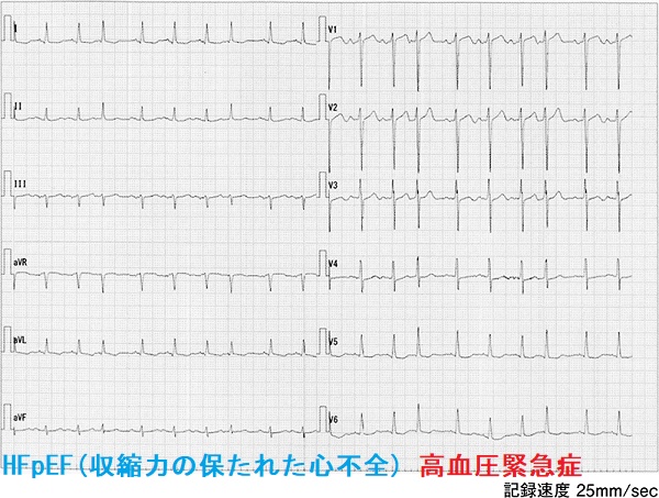 HFpEF(収縮力の保たれた心不全 高血圧緊急症 12 誘導心電図 HFpEF(収縮力の保たれた心不全 高血圧緊急症 12 誘導心電図