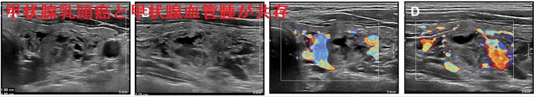 甲状腺乳頭癌と甲状腺血管腫が共存 甲状腺乳頭癌と甲状腺血管腫が共存
