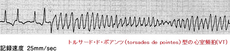 トルサード・ド・ポワンツ（torsades de pointes）の心電図