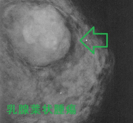 乳腺葉状腫瘍　マンモグラフィー