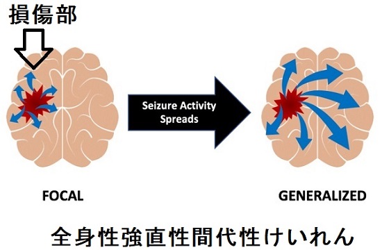 てんかんと甲状腺[日本甲状腺学会認定 甲状腺専門医 橋本病 バセドウ病 動脈硬化 甲状腺超音波エコー検査 甲状腺機能低下症長崎甲状腺クリニック(大阪)]