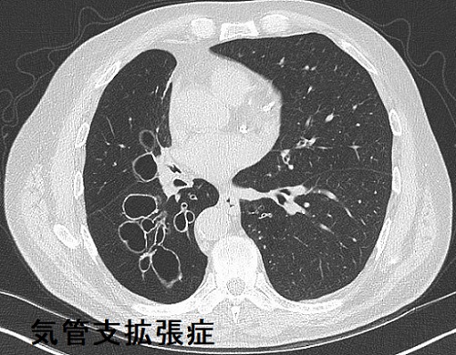 気管支拡張症 CT