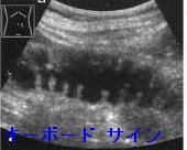 腸閉塞（イレウス）の腹部超音波（エコー） キーボード サイン