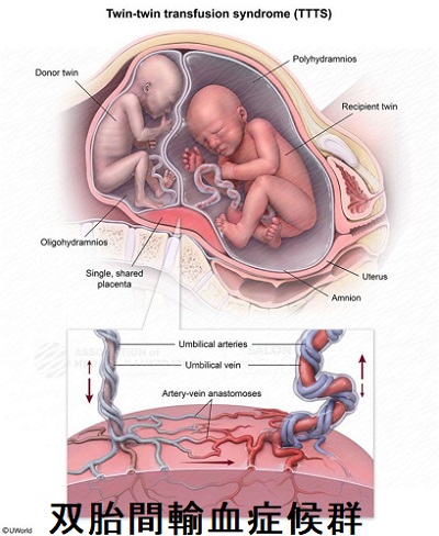 双胎間輸血症候群