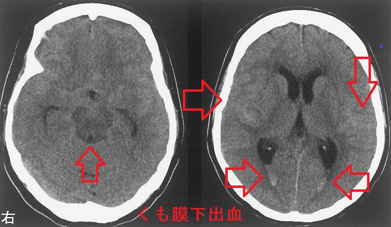 くも膜下出血　頭部CT画像