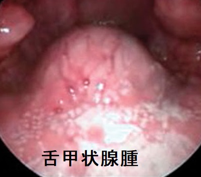 舌甲状腺腫