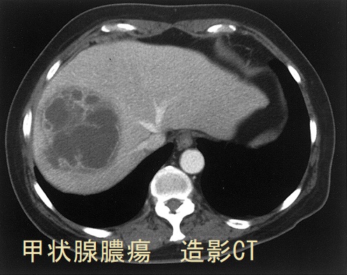 肝膿瘍 造影CT画像
