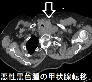 悪性黒色腫の甲状腺転移　CT画像