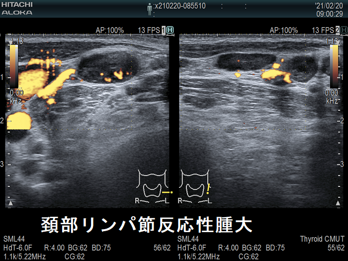 頚部リンパ節反応性腫大 超音波(エコー)画像 ドプラー