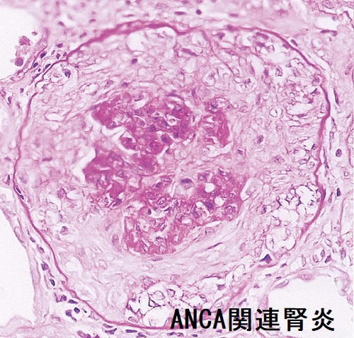 ANCA関連腎炎の腎生検