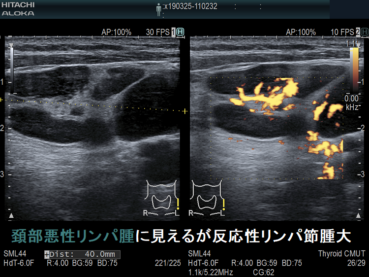 頚部悪性リンパ腫に見えるが反応性リンパ節腫大 超音波(エコー)画像