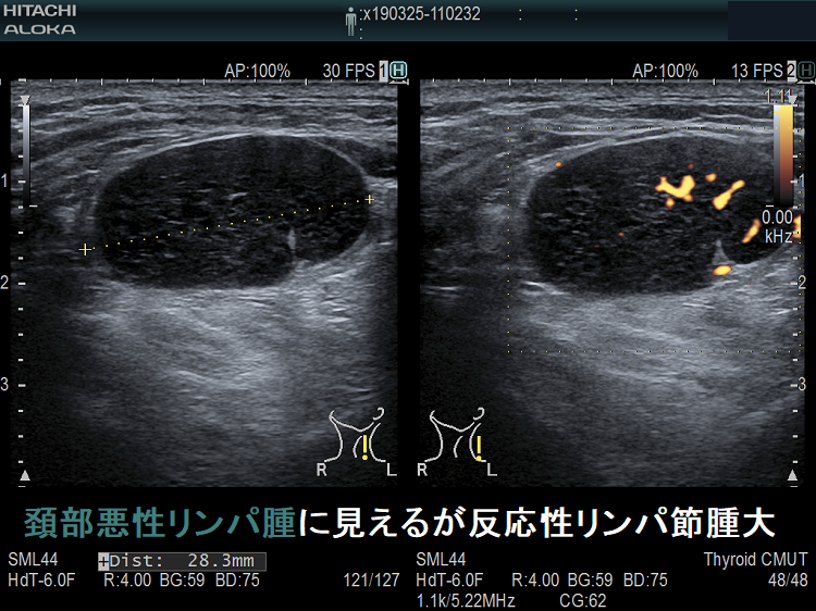 頚部悪性リンパ腫に見えるが反応性リンパ節腫大 超音波(エコー)画像