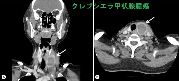 クレブシエラ甲状腺膿瘍 造影CT画像