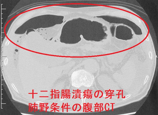 十二指腸潰瘍の穿孔 肺野条件の腹部CT 十二指腸潰瘍の穿孔 肺野条件の腹部CT