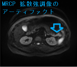 MRCP 拡散強調像(DWI)のアーティファクト MRCP 拡散強調像(DWI)のアーティファクト