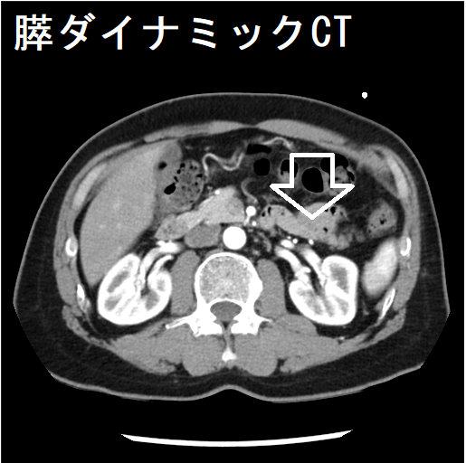 膵ダイナミックCT 膵ダイナミックCT