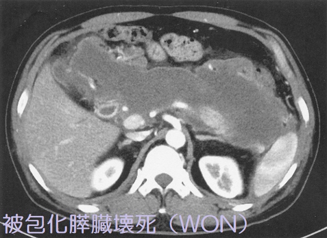 被包化膵臓壊死(WON)腹部造影CT 被包化膵臓壊死(WON)腹部造影CT