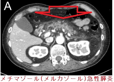 メチマゾール(メルカゾール)急性膵炎 造影CT像 メチマゾール(メルカゾール)急性膵炎 造影CT像