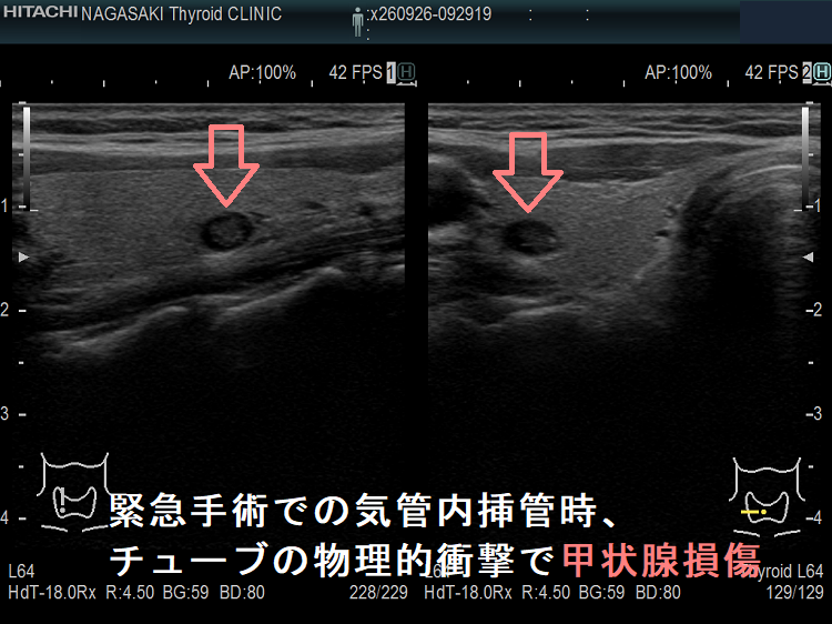 緊急手術での気管内挿管時、チューブの物理的衝撃で甲状腺損傷 緊急手術での気管内挿管時、チューブの物理的衝撃で甲状腺損傷