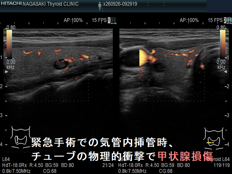 緊急手術での気管内挿管時、チューブの物理的衝撃で甲状腺損傷 ドプラーモード 緊急手術での気管内挿管時、チューブの物理的衝撃で甲状腺損傷 ドプラーモード