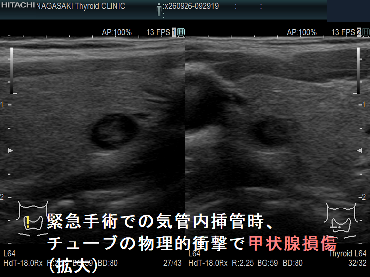 緊急手術での気管内挿管時、チューブの物理的衝撃で甲状腺損傷(拡大) 緊急手術での気管内挿管時、チューブの物理的衝撃で甲状腺損傷(拡大)