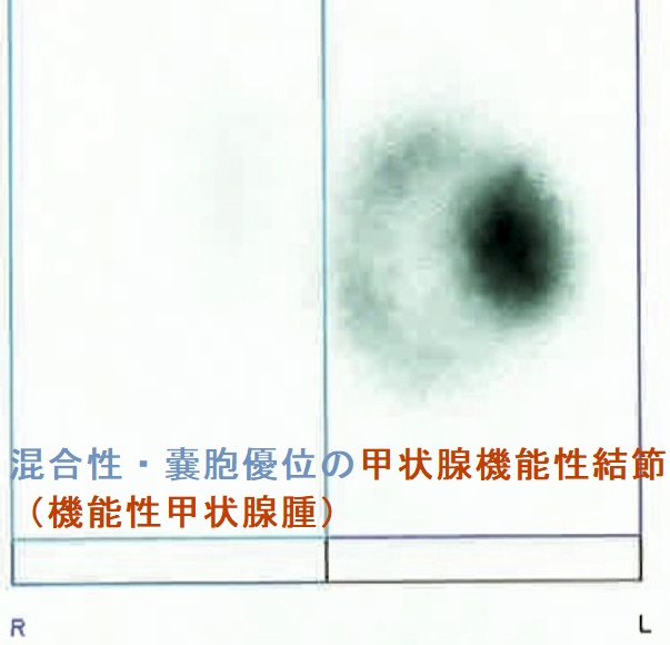 混合性・嚢胞優位の甲状腺機能性結節(機能性甲状腺腫) シンチグラフィー 混合性・嚢胞優位の甲状腺機能性結節(機能性甲状腺腫) シンチグラフィー