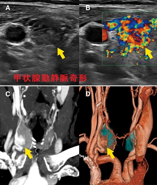 甲状腺動静脈奇形 甲状腺動静脈奇形