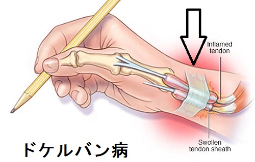 甲状腺と整形外科の病気①(頸肩腕)[日本甲状腺学会認定 甲状腺専門医 橋本病 バセドウ病 甲状腺エコー 甲状腺機能低下症 長崎甲状腺クリニック大阪]