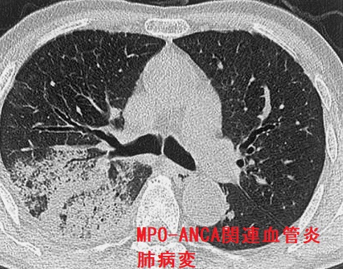 MPO-ANCA関連血管炎　肺病変
