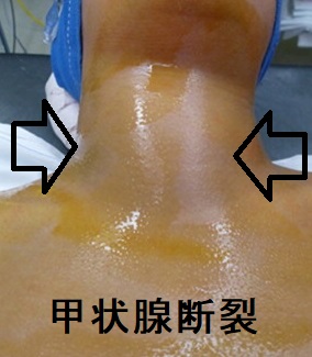 甲状腺断裂 甲状腺断裂