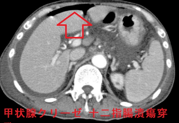 甲状腺クリーゼ  十二指腸潰瘍の穿孔