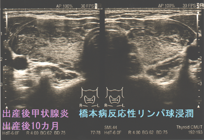 出産後甲状腺炎の橋本病反応性リンパ球浸潤 出産後10カ月