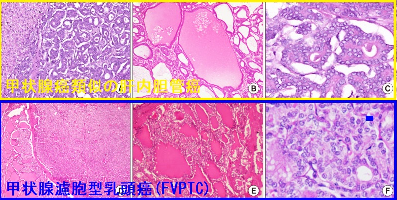 甲状腺濾胞型乳頭癌(FVPTC)と、甲状腺癌類似の肝内胆管癌