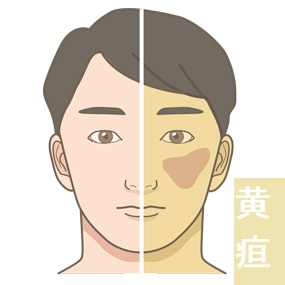 黄疸 黄疸